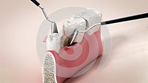 3D illustration of mid-crestal incision dental operation. 3D illustration photo