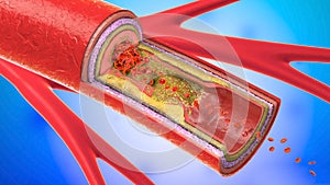 Illustration of a precipitated and narrowing blood vessel photo