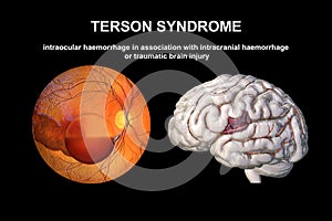 A 3D illustration of Terson syndrome, revealing intraocular hemorrhage observed during ophthalmoscopy and intracranial photo