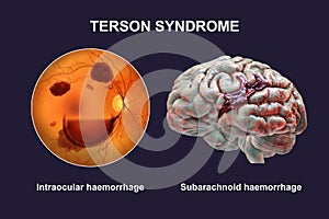 A 3D illustration of Terson syndrome, revealing intraocular hemorrhage observed during ophthalmoscopy and intracranial photo