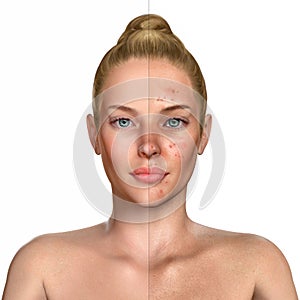 3d illustration of a woman before and after acne treatment procedure photo