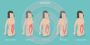 3D Isometric Flat Vector Conceptual Illustration of Abdominal Muscle Diastasis