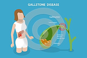 3D Isometric Flat Vector Conceptual Illustration of Gallstone Disease photo