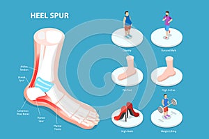 3D Isometric Flat Vector Conceptual Illustration of Heel Spur photo