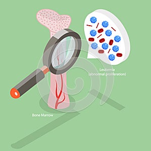3D Isometric Flat Vector Conceptual Illustration of Leukemia Disease photo