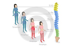 3D Isometric Flat Vector Conceptual Illustration of Tetraplegia And Paraplegia