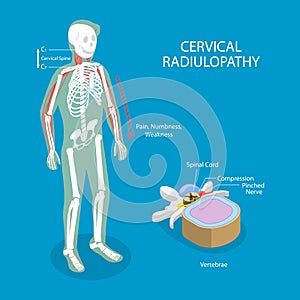 3D Isometric Flat Vector Illustration of Cervical Radiulopathy