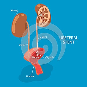 3D Isometric Flat Vector Illustration of Ureteral Stent photo
