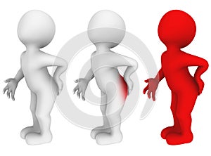 3d man with hemorrhoids