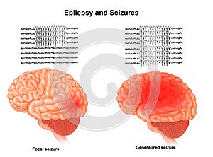 Medical illustration of Human Brain Epilepsy and Seizures photo