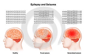 Medical illustration of Human Brain Epilepsy and Seizures photo