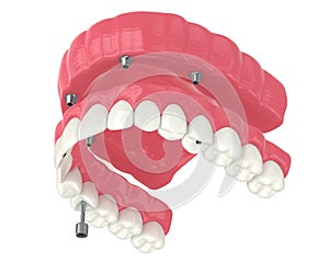 3d render of all on 4 dental implants treatment