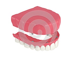 3d render of all on 4 dental implants treatment