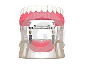 3d render of bar retained removable overdenture installation supported by two implants