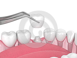 3d render of crown replacement on reshaped tooth