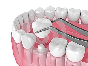 3d render of crown replacement on reshaped tooth