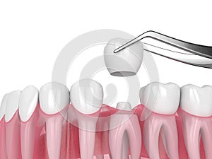 3d render of crown replacement on reshaped tooth