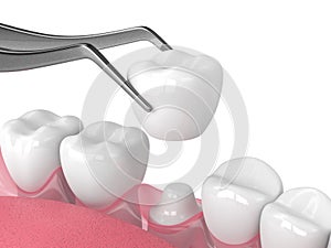 3d render of crown replacement on reshaped tooth