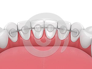 3d render of dental bonded retainer on lower jaw photo