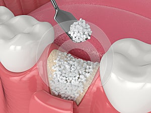 3D render of dental bone grafting with bone biomaterial application