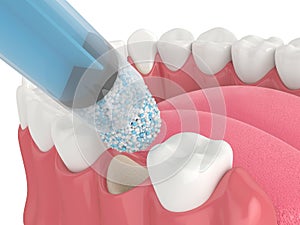 3D render of dental bone grafting with dental bone biomaterial application