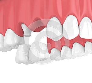3d render of dental cantilever bridge with crowns in upper jaw photo