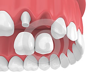 3d render of dental cantilever bridge with crowns in upper jaw photo