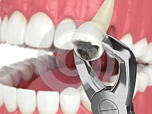 3d render of dental forceps with extracted tooth photo