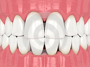 3d render of human jaw with black triangles