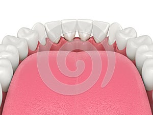 3d render of human lower jaw with black triangles