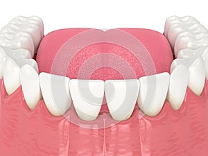 3d render of human lower jaw with black triangles
