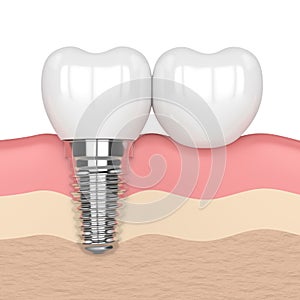 3d render of implant with dental cantilever bridge photo