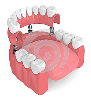 3d render of implant partial denture