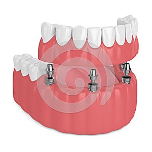 3d render of implant partial denture photo