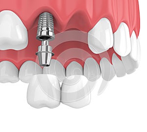 3d render of implants with dental cantilever bridge in upper jaw photo