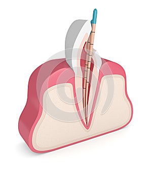 3d render of incisor tooth with gutta percha photo