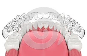 3d render of invisalign removable retainer with lower jaw photo