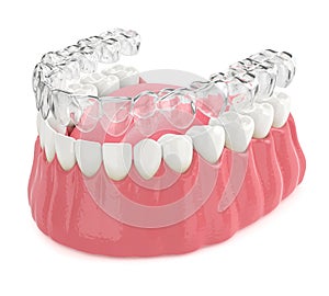 3d render of invisalign removable retainer with lower jaw photo