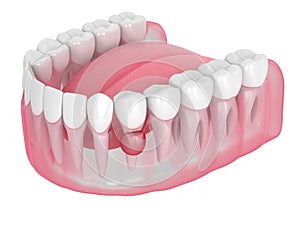 3d render of jaw with cyst on root