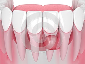 3d render of jaw with cyst on teeth root