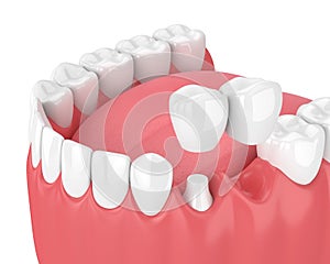 3d render of jaw with dental cantilever bridge photo