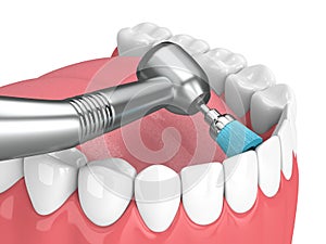 3d render of jaw with dental handpiece and polishing brush photo