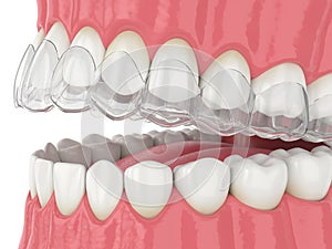 3d render of jaw with invisalign removable retainer photo