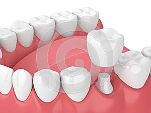 3d render of jaw with teeth and dental crown restoration photo