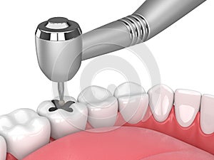 3d render of jaw with teeth, dental handpiece and drill photo