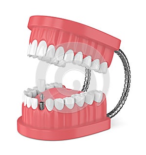 3d render of jaw with teeth and dental incisor implant