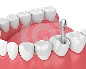 Gráficos tridimensionales renderizados por computadora de mandíbula dientes a a publicar 