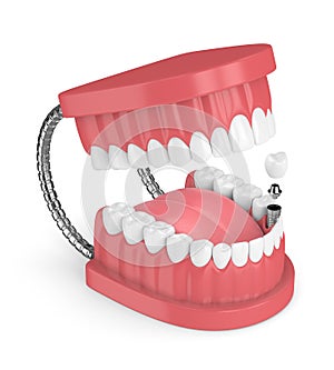 3d render of jaw with teeth and dental premolar implant photo