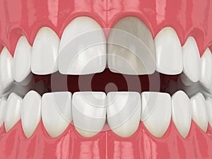 3d render of jaw and tooth with dead pulp