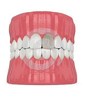 3d render of jaw and tooth with dead pulp